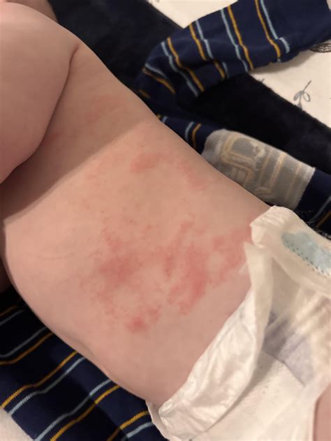 Ringworm Rash Baby Is This Ringworm On My Baby's Chest? : R/newborns