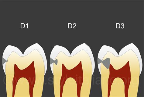 Initial caries: management for minimal intervention - styleitaliano.org