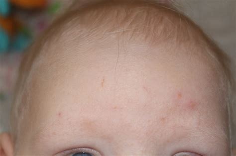 Сыпь у ребенка и красные пятна (фото) — 7 ответов | форум Babyblog