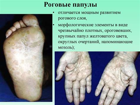 Вторичный период сифилиса - презентация онлайн