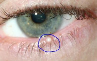 How To Remove Milia In Eyelid - HOWOTREMVO