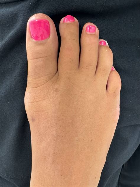 Minimally Invasive Bunion Surgery | Northwest Surgery Center