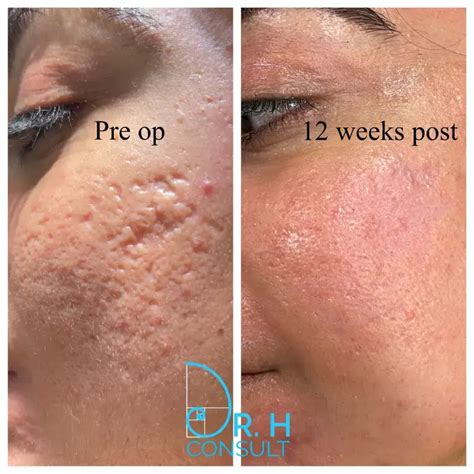 Acne Scar Laser Treatment & Removal London | Dr H Consult