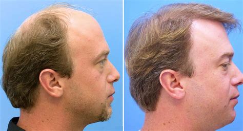 3 Perfect Hair Transplant Before and After - In NewsWeekly