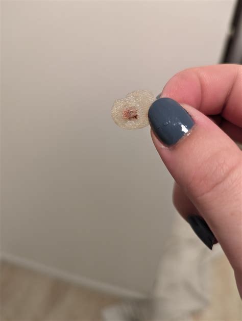 Plantar wart after salicylic acid and freezing : r/Warts