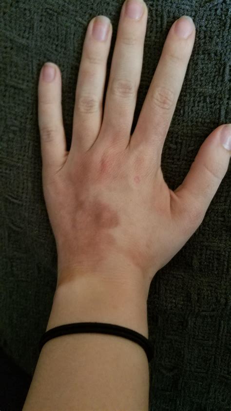 [Skin Concerns] The dark spots appeared overnight. I'm only 24. It