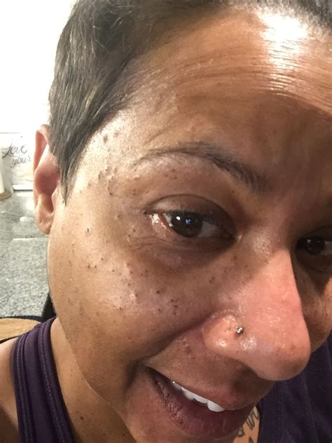 The Infamous Face Mole — Rita Fuller-Yates