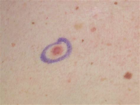 early stage skin cancer medical pictures info lepromatous leprosy