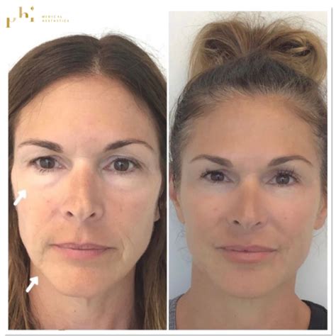 Botox Cosmetic Services in Calgary — PHI Medical Aesthetics