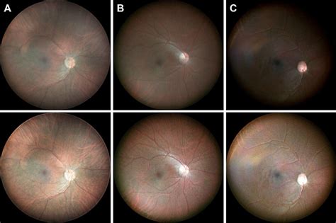 Color balanced fundus images from various pigmentation subjects. Fundus ...