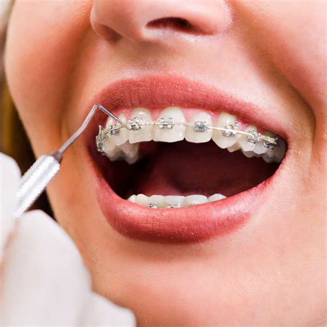 ¿Qué es el apiñamiento dental y cómo corregirlo? • Clínica Dental AVODENT