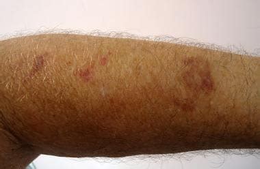 purpura