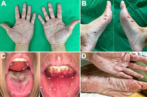 Hand Foot And Mouth Disease In Adults