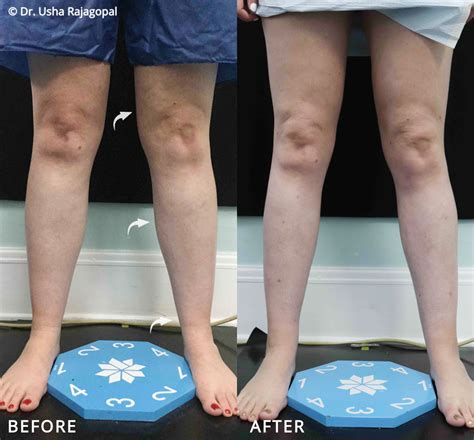 Ankle Liposuction | Usha Rajagopal, MD