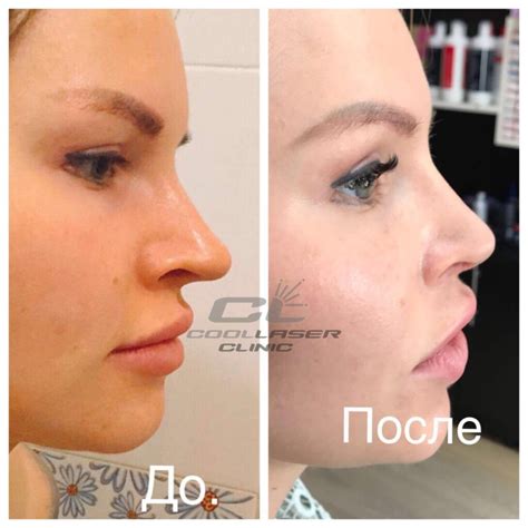 Ринопластика в Києві - Coolaser Clinic