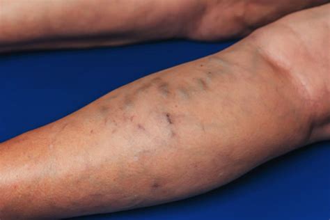 Cardiology: Superficial thrombophlebitis and cannula phlebitis ...