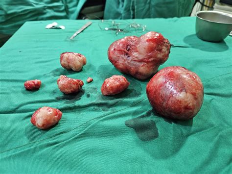Miomectomia O Que É - Miomectomia: Entenda o Procedimento e Suas Indicações - Dr Adalberto ...