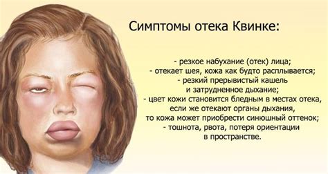 Отек квинке: симптомы и лечение в домашних условиях, фото больных