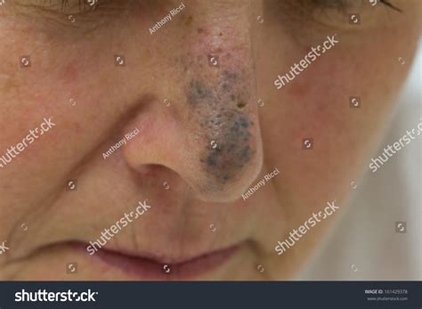 blue nevus  nose female stock photo  shutterstock