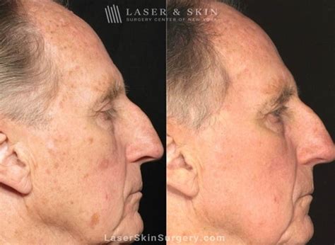 laser brown spot removal  york ny laser center