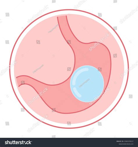 Gastric Bypass Surgery Band Roux En Stock Vector (Royalty Free