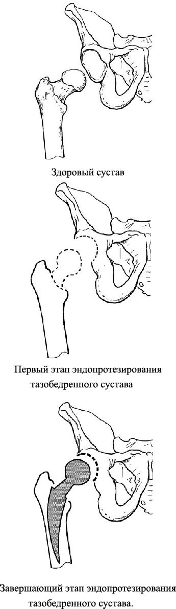 Оперативное лечение коксартроза — эндопротезирование тазобедренных ...