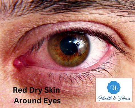 dry skin  eyes hormones  numbers mcleod blog