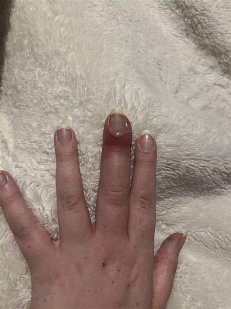 My infected finger this morning after I popped it last night : r/popping