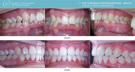 orthodontie adulte orthodontie des grands moulins
