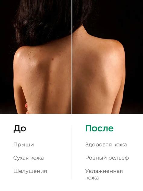 Likato NO ACNE SKIN Увлажняющее молочко-флюид для тела против ...