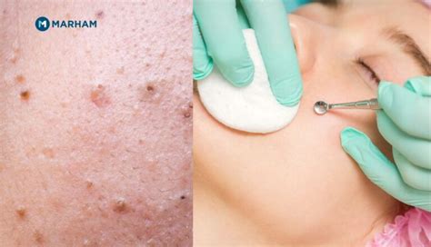 Unbelievable Blackhead Removal 2024: The Ultimate Guide for Clear Skin - v7d71c6