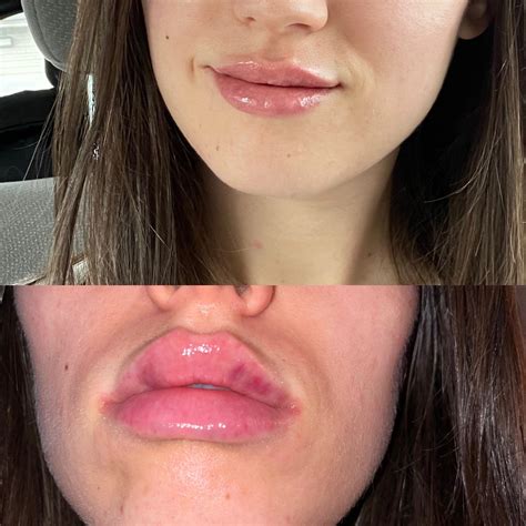 Lip Filler Bruising And Swelling at Vivian Bernhardt blog