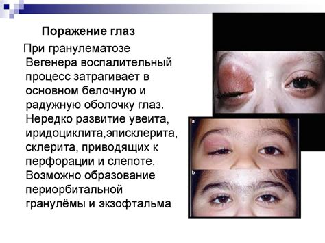 Гранулематоз Вегенера - презентация онлайн