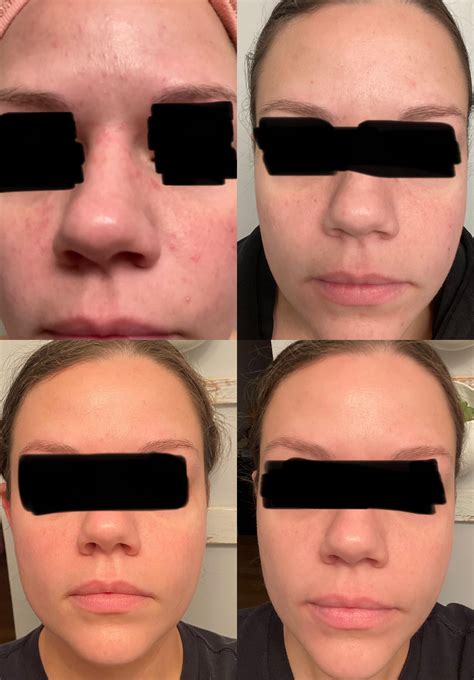 Fungal acne progress : r/SkincareAddicts