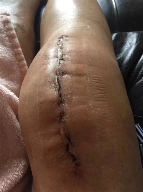 Woman transforms scar on her knee - using cheap cream from Poundland