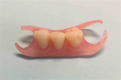 partial denture | Dr. Gentry 