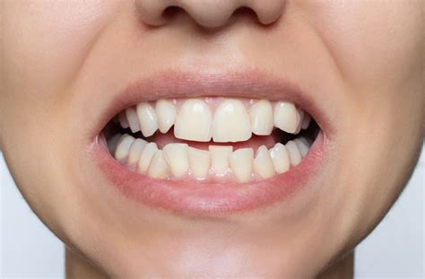 fix crooked teeth markham dental smiles