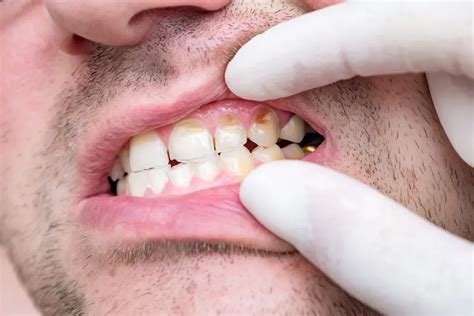 What Is the Best Solution for a Chipped Tooth? | Pediatric Dentistry ...