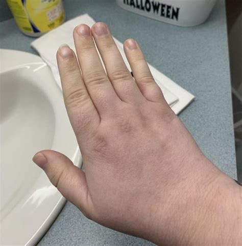 mild raynauds hands   coldpainfulnumb  fingers