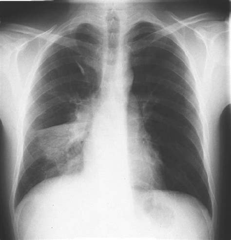 Lobaari pneumokokkipneumonia