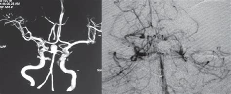 years female symptomatic  unruptured left pcom aneurysm treated