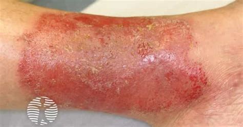 Discoid eczema image