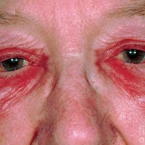 neonatal chlamydial conjunctivitis photograph  western ophthalmic