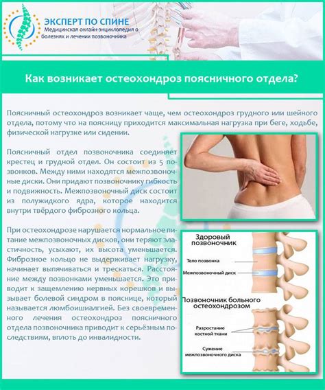 Лечение остеохондроза шейного, грудного и поясничного отдела: методы ...