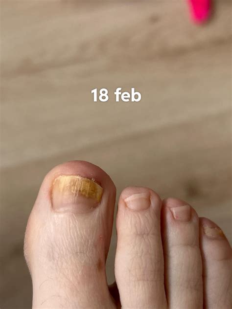 Progress after 2,5 months of Terbinafine : r/NailFungus