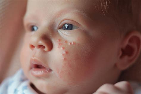 Acne Neonatal Como Tratar - Acne neonatal: como tratar de uma vez por todas