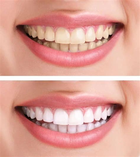 foods  stain teeth    prevent  dentalyorg