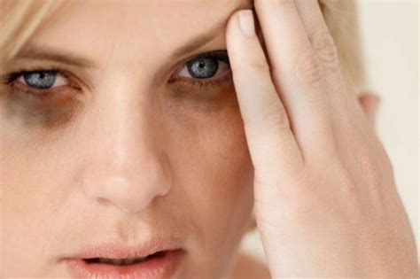 nak menghilangkan lebam bawah mata juniorknoealvarez