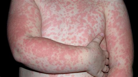 common skin rashes christ memorial