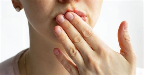 8 причини за напукани устни - Az-jenata